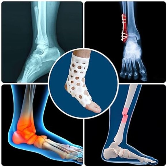 CHAMPK 3D FRACTURE BRACE *NEW* - Picture 1 of 5